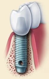 Reclaiming Your Smile With Dental Implants