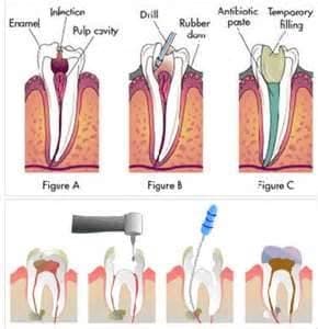 How Can Root Canals Help?