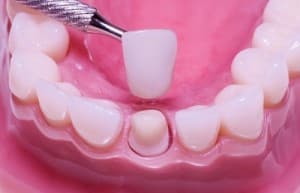 Veneers, Crowns, and Inlays and Onlays: When to Have Them?
