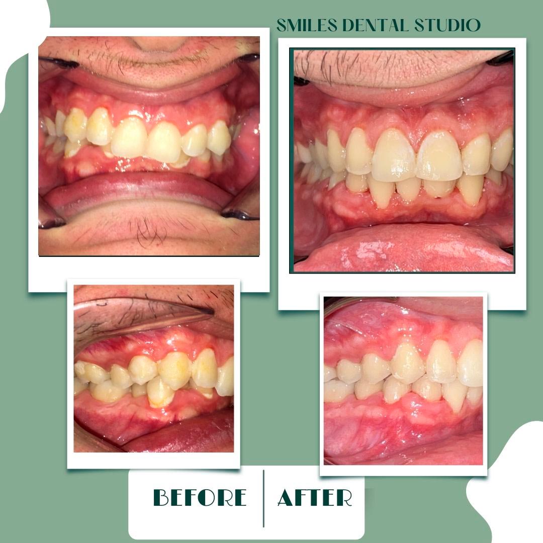 Smile Dental Studio braces before and after